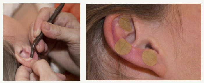 Ohr-Akupunkt-Meridianmassage (OAM)